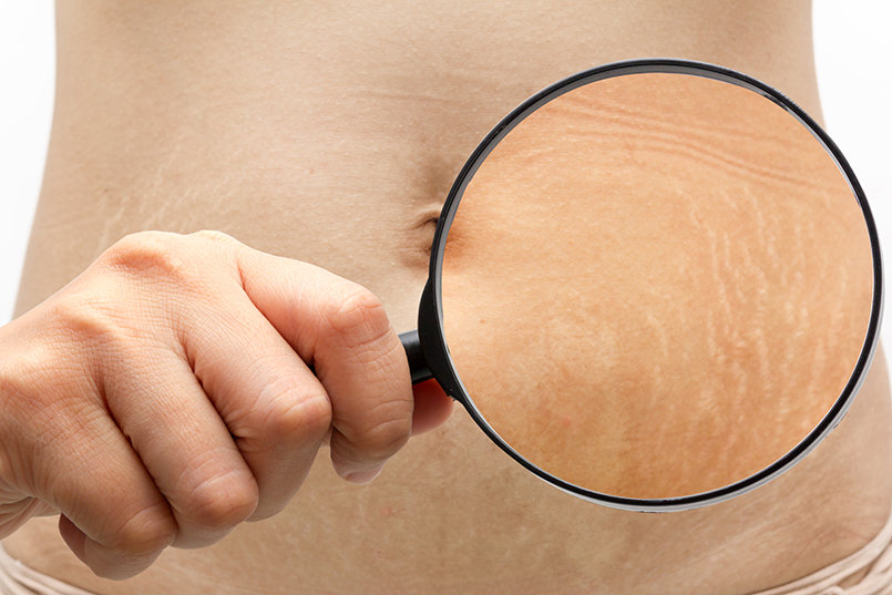 Stretch Marks In Teenagers – How They Develop And How To Treat Them